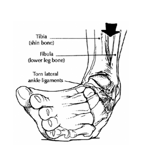 injury machenism